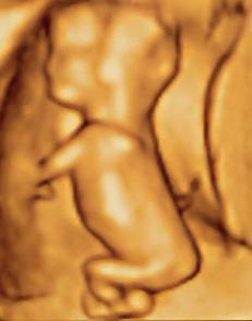 3d Ultrasound at 14 weeks