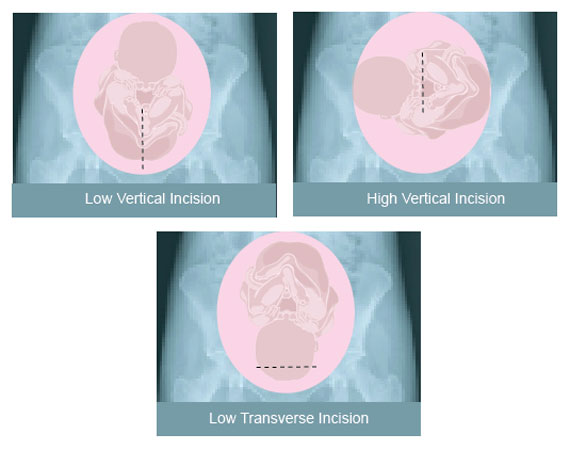 Incisions in uterus for cesarean