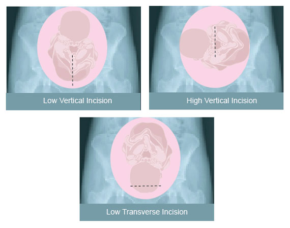 Incisions in uterus for cesarean birth