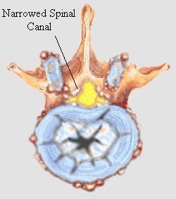 Bone spurs on vertebral disk