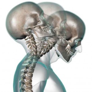 How rebound brain injury happens How rebound brain injury happens