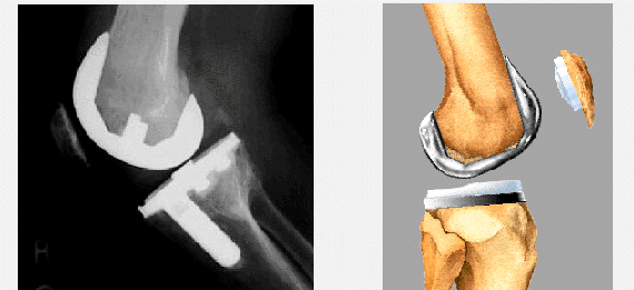 Xray from the side compared with illustration of knee prosthesis