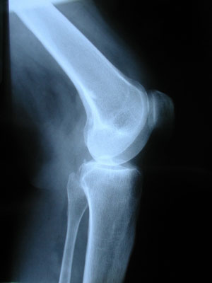 Xray of normal knee