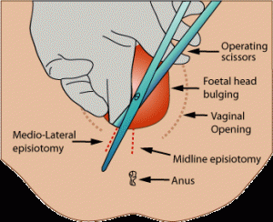 Medio-lateral episiotomy Mediolateral episiotomy