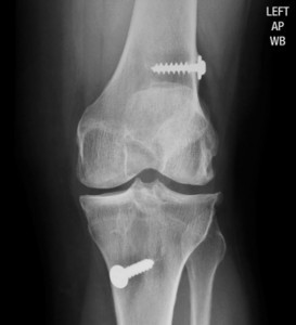 Xray after ACL repair