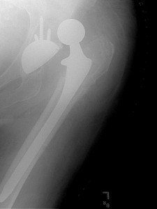 Xray of dislocated hip prosthesis