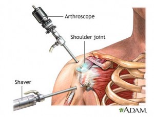 shoulder-arthroscopy-illustration-adam