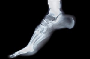 Foot Xray on toes