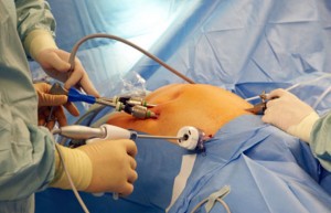 Laparoscopy - shows instruments in the abdomen Laparoscopy - shows the abdomen is distended with gas inside and instruments placed in the abdomen
