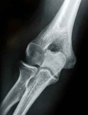 X Ray Elbow