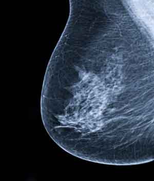 breast-cancer-xray