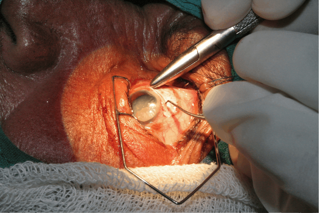 CataractSurgery