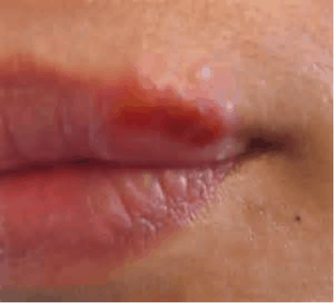 Heat blisters on lip deals