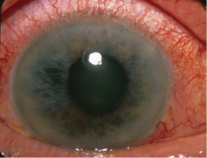 GlaucomaIntro