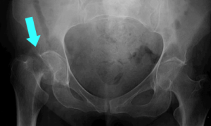 Hip Fracture