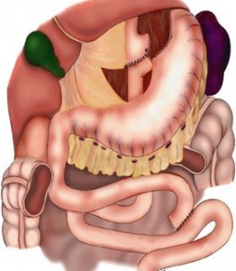 Roux-en-Y Procedure