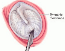 Myringotomy