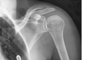 Xray_Shoulder