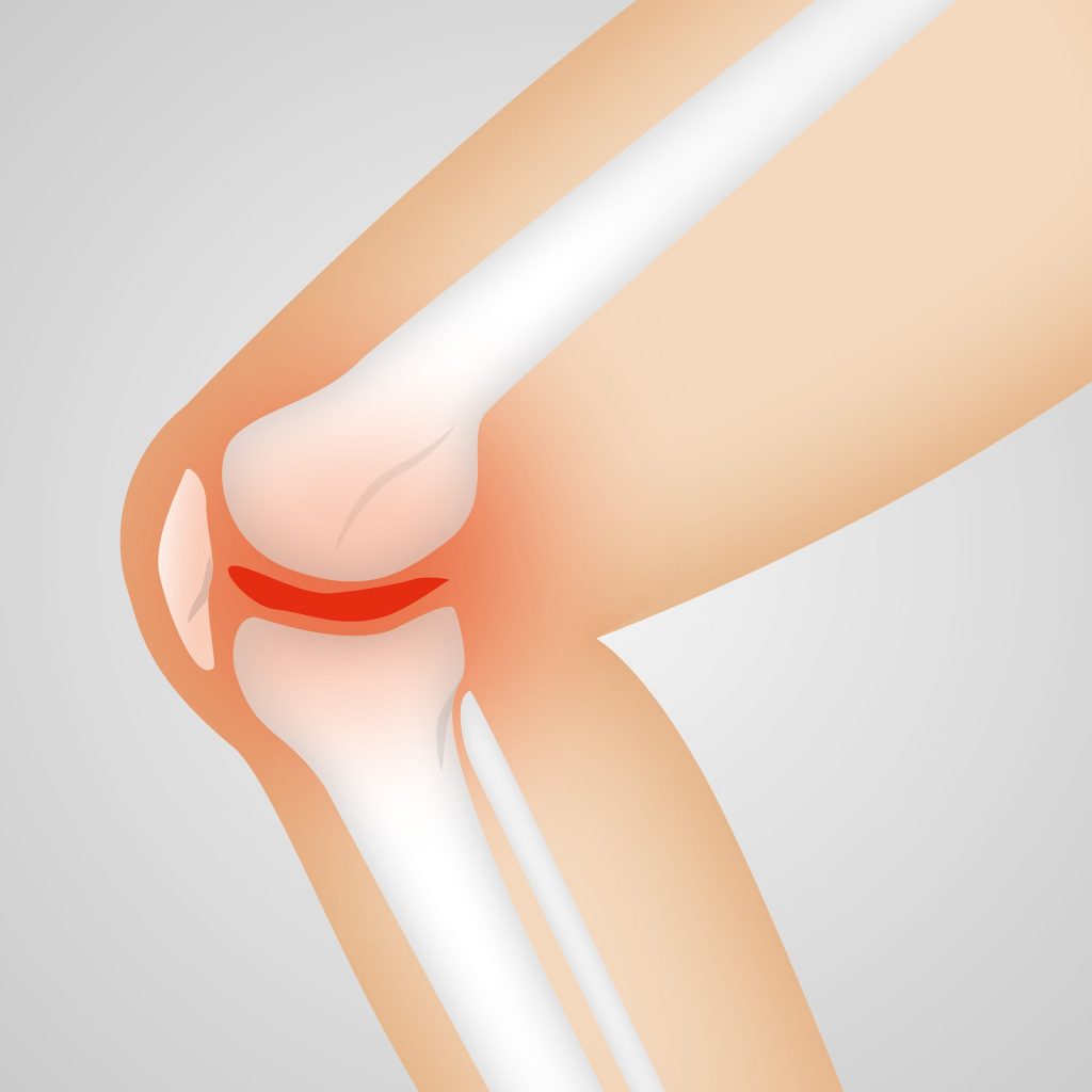 Meniscus Injury