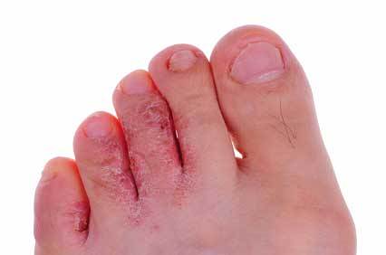 Athlete S Foot Children Ages 1 18 Treatment At Home