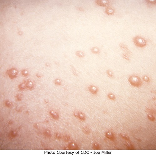 chicken pox pictures in adults