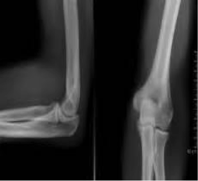 Elbow Anatomy x-ray