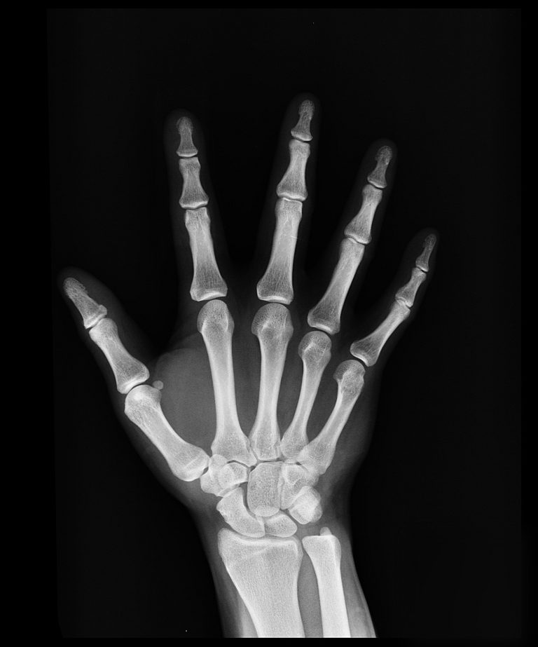 An x ray image of a man's right hand