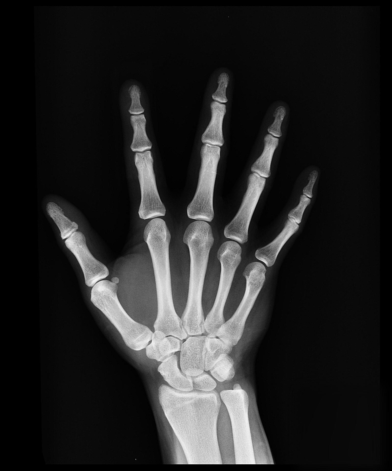 Broken Index Finger X Ray