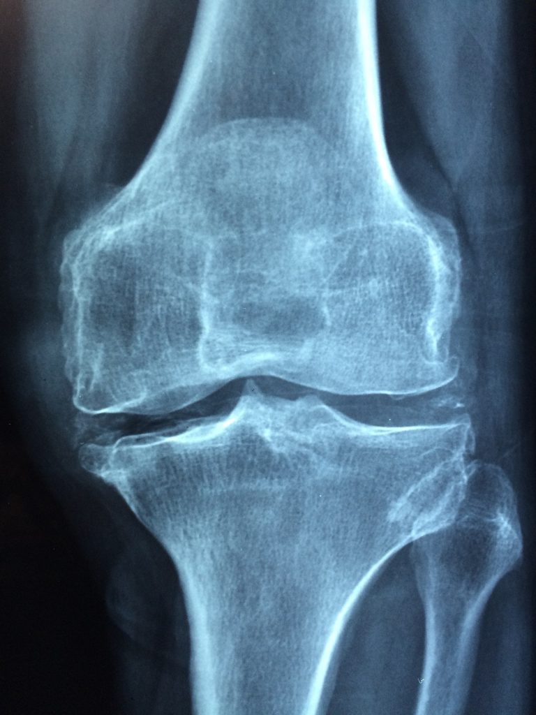 x ray of a knee joint that was injured and has deteriorated