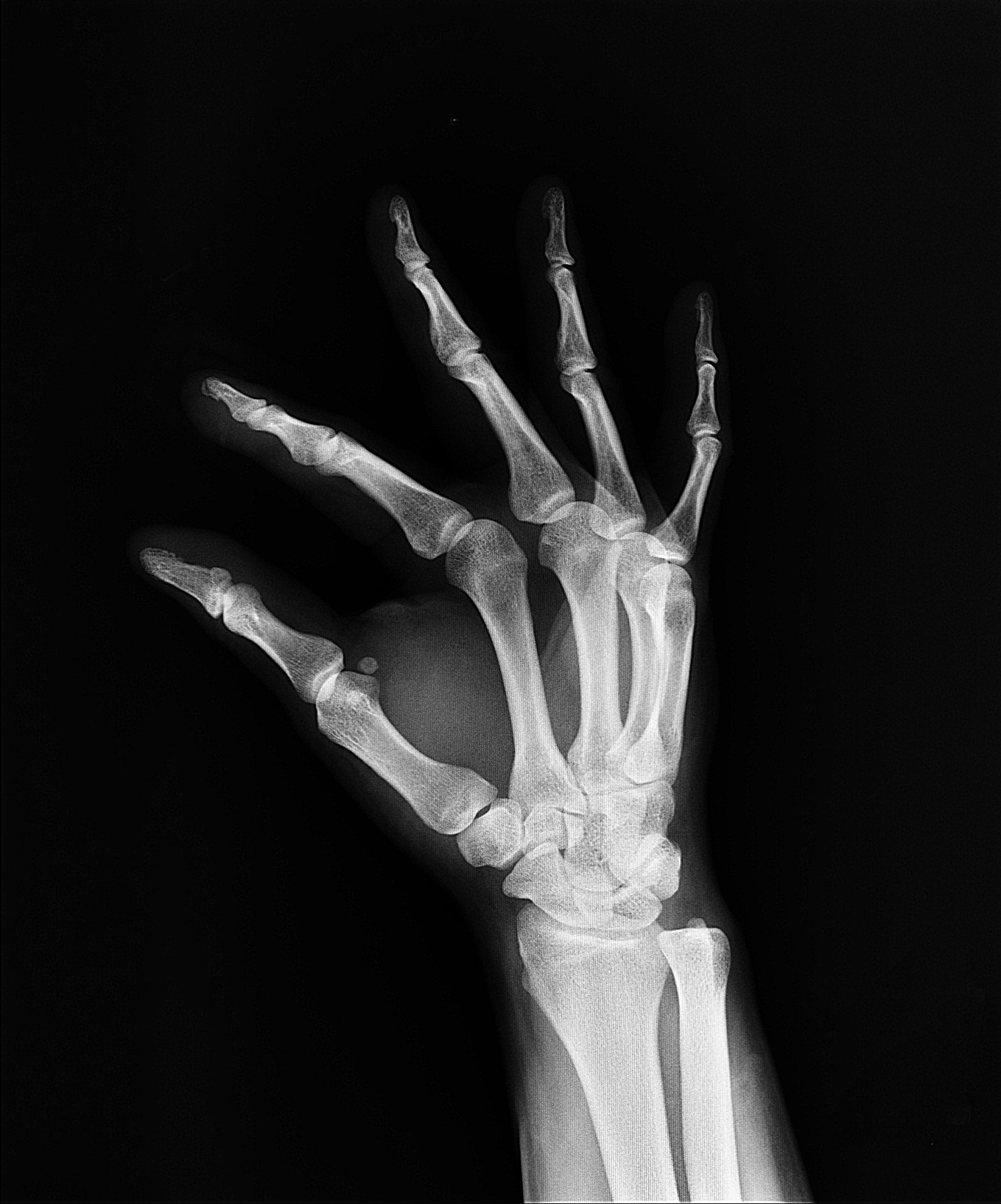 Hand XRay